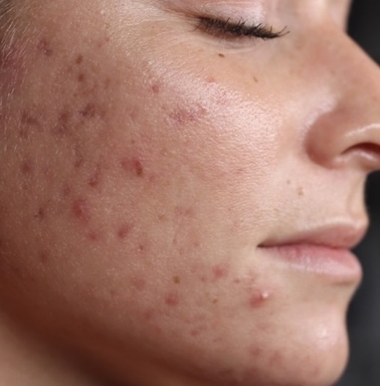 Inflammatory acne - documented skin journey